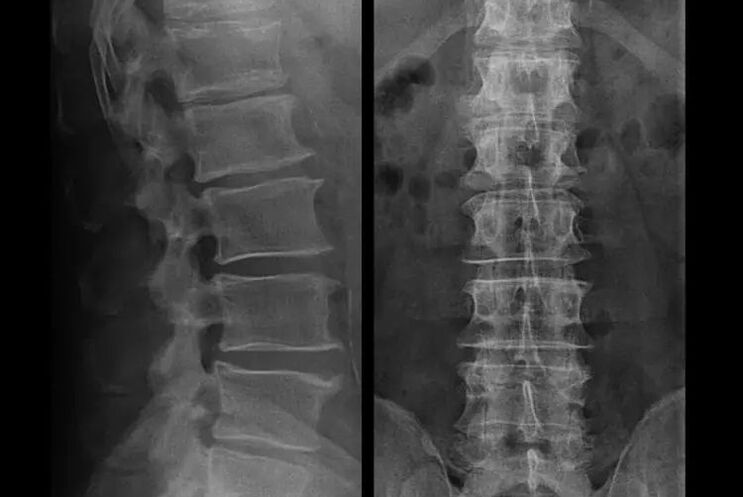 Osteochondrose op Röntgen