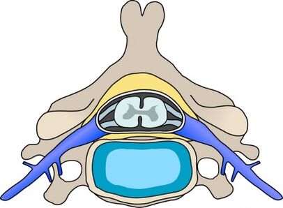 Protabius an der Wirbelen mat Gebärmutteral OsteOchondrosis